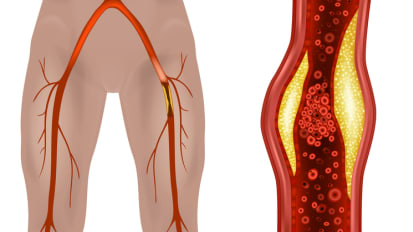 What Referring Physicians Need to Know About Current Peripheral Artery Disease Guidelines