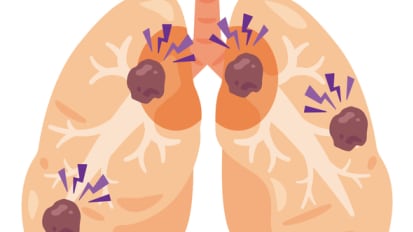 Expanding Treatment Options for Brain Metastases in NSCLC