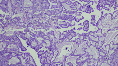 A New Era for Pancreatic Cancer: How Baptist Health Research Helped Get Us Here