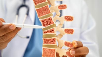 Beyond Bone Density: How Fracture Risk Is Changing Osteoporosis Management