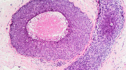 DCIS and Active Monitoring: When Immediate Surgery May Not Be the Only Conversation