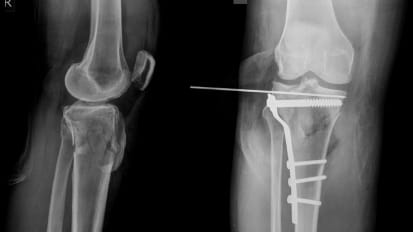No Bones About It: Baptist Health Is a Growing Hub for Orthopedic Care