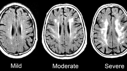 Mid- to Late-Life Increases in Marker of Chronic Inflammation Tied to Dementia