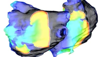 Don’t Miss a Beat: Computer Simulations May Treat Most Common Heart Rhythm Disorder