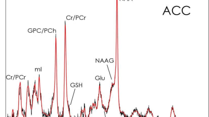 Measuring Differences in Brain Chemicals in People with Mild Memory Problems