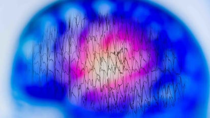 A Potential Breakthrough for Patients with Drug-Resistant Epilepsy