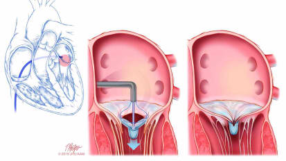 A Minimally Invasive Approach for Mitral Valve Repair