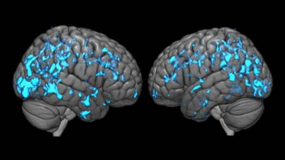 Deep Brain Stimulation Eases Parkinson’s Disease Symptoms by Boosting Dopamine