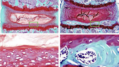 ‘Swiss Cheese’ Bones Could Be Cause of Unexplained Low Back Pain