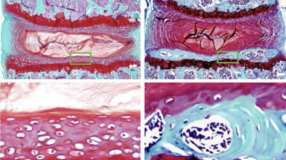 ‘Swiss Cheese’ Bones Could Be Cause of Unexplained Low Back Pain