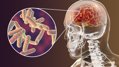PET Scans May Optimize Tuberculosis Meningitis Treatments and Personalize Care, Study Finds