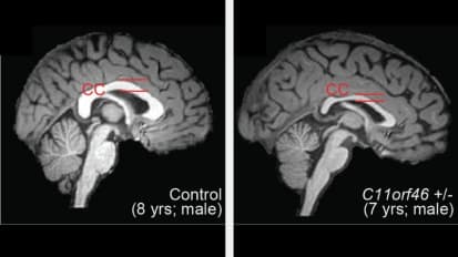 Genetic Syndrome of Intellectual Disability Fixed in Mice Using Precision Epigenome Editing