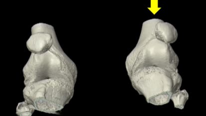 Innovating Treatment for Recurrent Patellar Instability