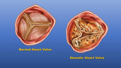 Study: Race and Ethnicity May Impact Prevalence and Treatment of Heart Valve Dysfunction