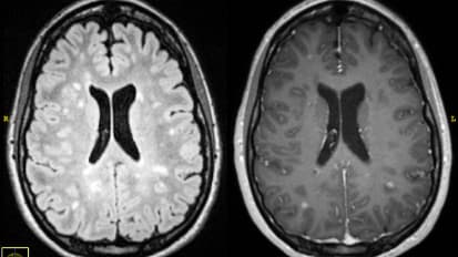 Ofatumumab for Relapsing Multiple Sclerosis