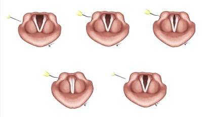 New Laryngopharyngeal Sensitivity Test Could Transform Patient Care