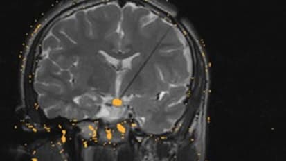 Laser Surgery – Changing Management and Outcomes of Hypothalamic Hamartomas/Update on Laser Surgery for Pediatric Epilepsy 