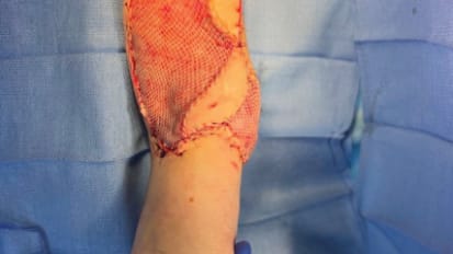 Multidisciplinary Limb Preservation Program Saves Steps to Help Save Limbs