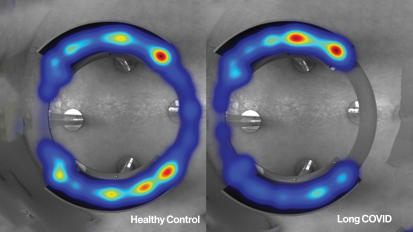 Breaking Ground on Long COVID's Impact on Biology and Its Immunologic Basis