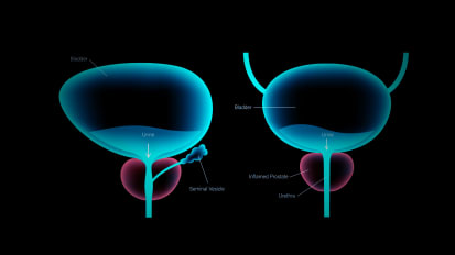 Better Diagnosis Holds the Key to Improved Outcomes for BPH Patients