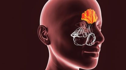 New Therapy Could Help Patients with Chronic Rhinosinusitis With Nasal Polyps