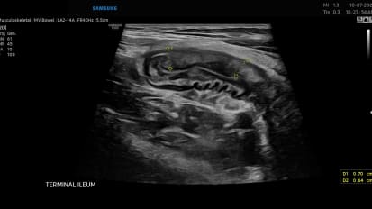 Mount Sinai Brings Patient-Centric Intestinal Ultrasound to North America