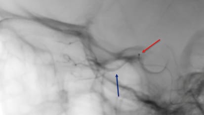 Intra-Arterial Chemotherapy Is a Game Changer for Patients With Retinoblastoma