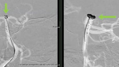 As Technology Progresses, Aneurysm Treatments Become Safer and More Reasonable to Consider