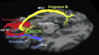 Abbott Initiates Clinical Study to Evaluate the Use of Its Deep Brain Stimulation System to Manage Severe Depression
