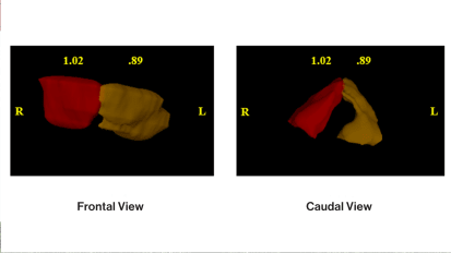 Using 3D Modeling to Enhance Surgery Among Patients With Paralyzed Vocal Cords