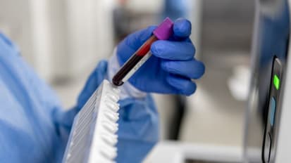 Liquid Biopsy “Reliable and Accurate” With Early Cancer Detection