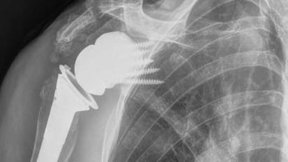 Advancing Shoulder Arthroplasty With 3D Technology