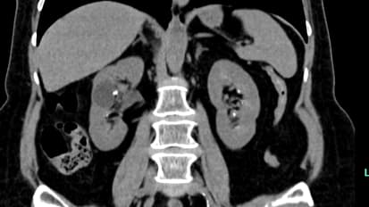 Ureteroscopies Without Wires and Stents Could Be the Field’s Next Gold Standard