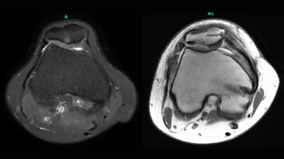 Mount Sinai Surgeon Aims to Optimize Outcomes for Patellofemoral Patients