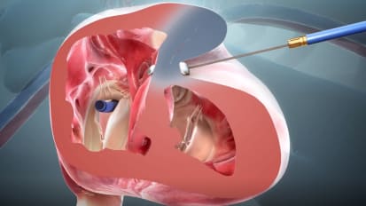 First in Florida: Miami Cardiac & Vascular Institute ‘Reshapes’ Heart in Critical Patient to Improve Blood Flow