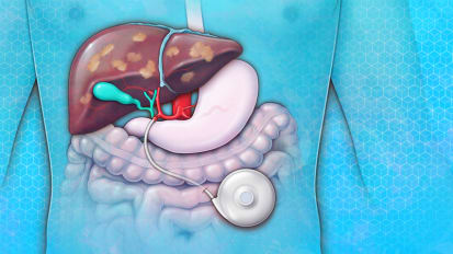 A Life-Extending Study for Colorectal Cancer Patients with Inoperable Liver Metastases