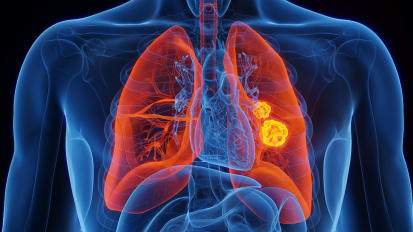Lung cancer treatment shows promise in tumor models