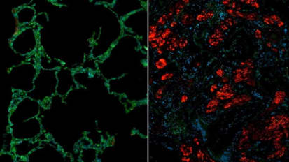 Reversing Lung Fibrosis in Scleroderma Requires Increase in Antifibrotic Proteins