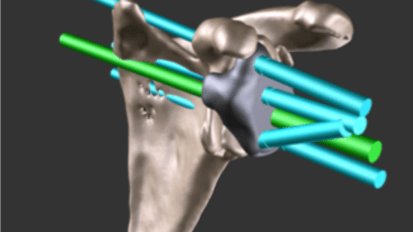 Computer Modeling Improves Outcomes in Reverse Total Shoulder Replacement