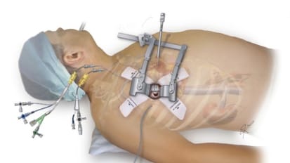 Minimally Invasive Valve Replacements Reduce Healing Time, Scars