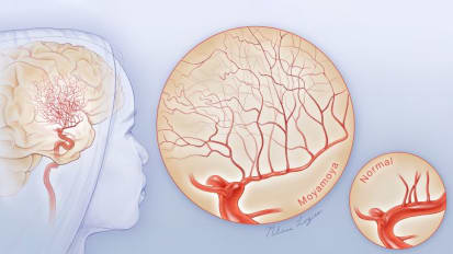 ER Visit Leads to Moyamoya Disease Diagnosis and Personalized Treatment Plan: UCSF Case Study