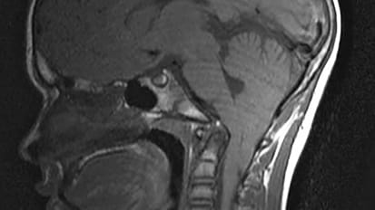 Better Understanding of Chiari Malformation