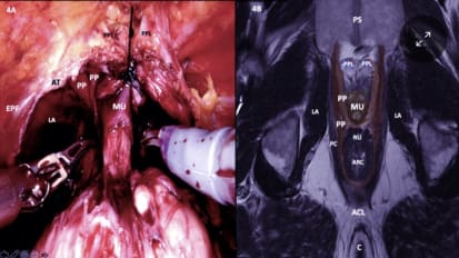 Hood Technique Enables Early Return to Continence Following RARP