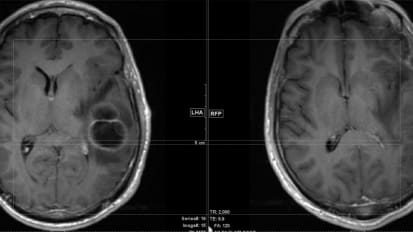 Awake Craniotomy with Fluorescent Guidance: A Case Study 