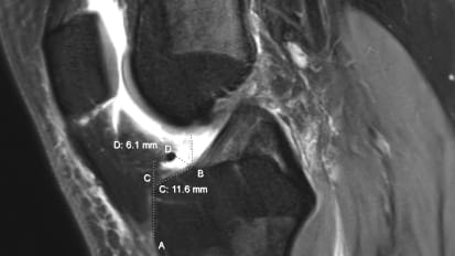 2D and 3D MRIs Provide Reliable Measurements for Planning ACL Surgery