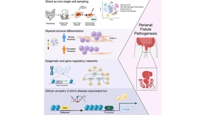 Mount Sinai Researchers the First to Apply Single-Cell Analysis to Reveal Mechanisms of a Common Complication of Crohn’s Disease