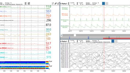 The Emerging Role of Multimodality Neurologic Monitoring in Pediatric Neurocritical Care 