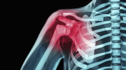 CT Navigation Helps Surgeons To Optimize Total Shoulder Arthroplasty
