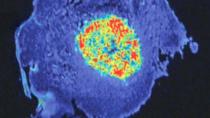 Illuminating cancer: New pH threshold sensor improves cancer surgery