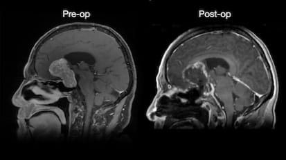 Endoscopic Removal of a Giant Pituitary Adenoma: A UCSF Case Study